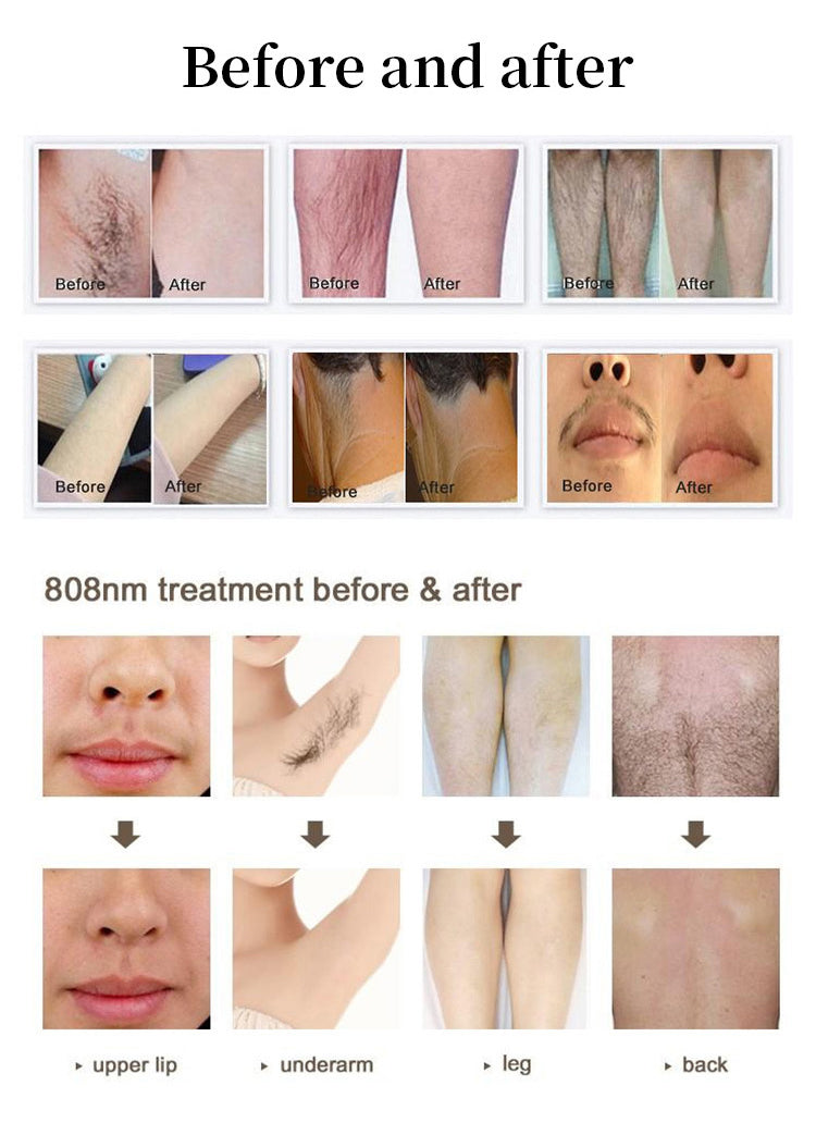 big screen laser hair removal machine hair free medspa machine